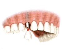 DENTAL IMPLANTS